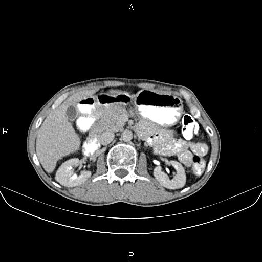 File:Colon adenocarcinoma - hepatic flexure (Radiopaedia 85635-101395 Axial C+ delayed 33).jpg