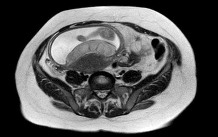 Colon adenocarcinoma with Krukenberg tumors, advanced pregnancy (Radiopaedia 67279-76645 Axial T2 27).jpg