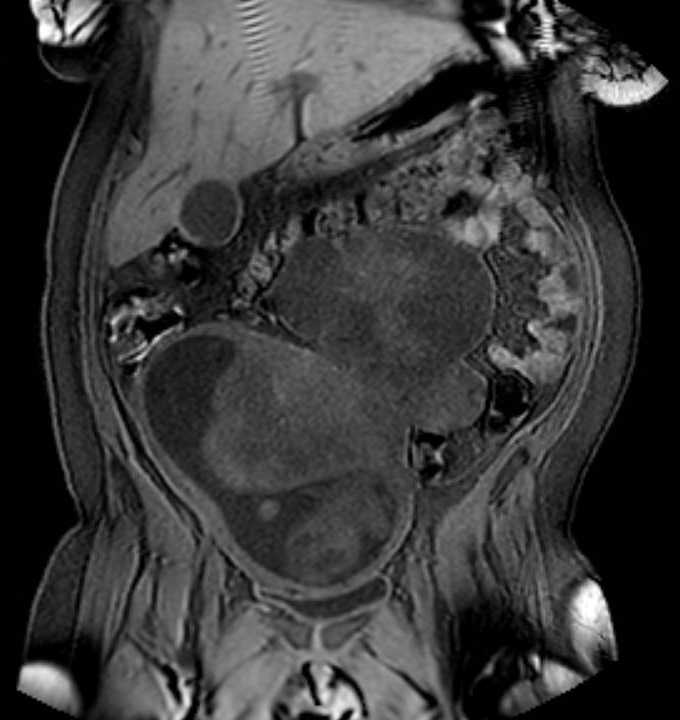 Colon adenocarcinoma with Krukenberg tumors, advanced pregnancy (Radiopaedia 67279-76645 E 30).jpg