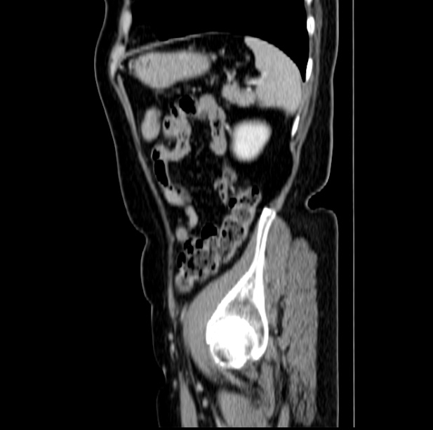 Colon carcinoma with hepatic metastases (Radiopaedia 29477-29961 C 45).jpg