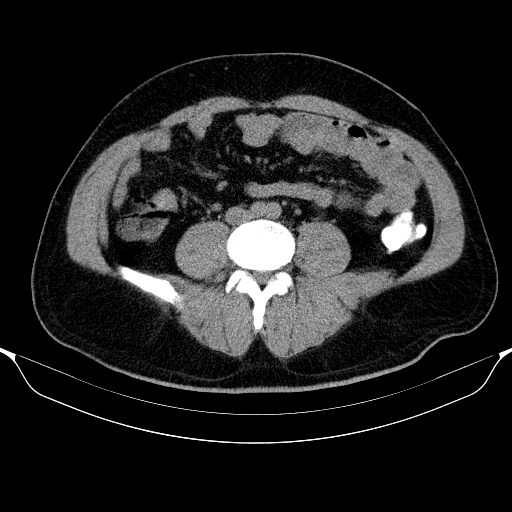 Colonic lipoma with colo-colic intussusception (Radiopaedia 58944-66200 Axial C+ rectal 40).jpg