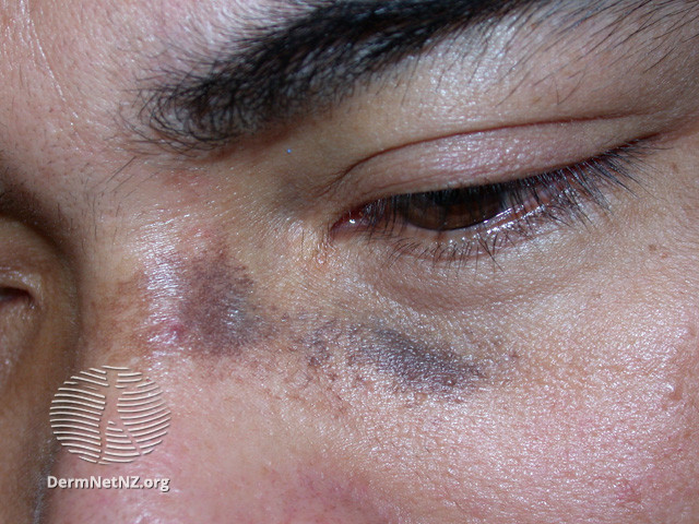 File:Naevus of Ota (DermNet NZ lesions-ota3).jpg