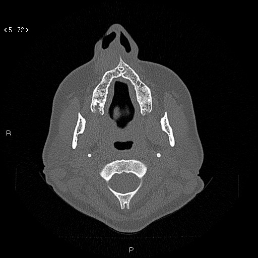 Nasolabial cyst (Radiopaedia 75125-86194 Axial bone window 33).jpg