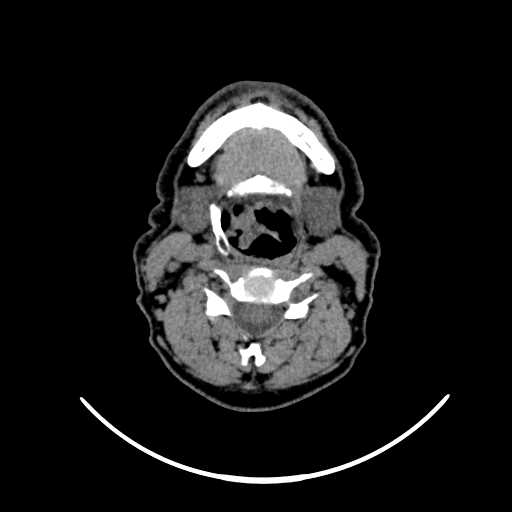 File:Nasopharyngeal carcinoma - infiltrating the clivus (Radiopaedia 62583-70875 Axial non-contrast 42).jpg