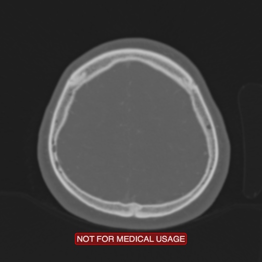 File:Nasopharyngeal carcinoma recurrence - skull base destruction (Radiopaedia 29107-29490 Axial bone window 23).jpg