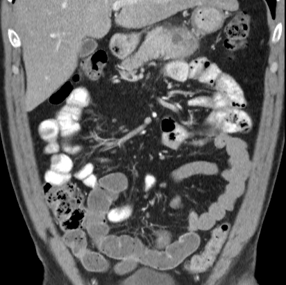 File:Necrotizing pancreatitis with acute necrotic collection (Radiopaedia 14470-14417 C 11).jpg
