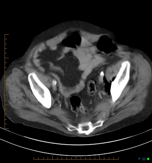 Necrotzing fasciitis due to a perforated adenocarcinoma of the splenic flexure (Radiopaedia 46930-51455 A 53).jpg