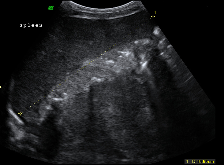 File:Neonatal neuroblastoma (Radiopaedia 9564-10221 A 7).jpg