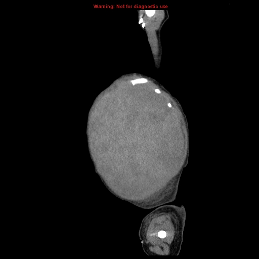 File:Neonatal neuroblastoma (Radiopaedia 9564-10223 C 17).jpg
