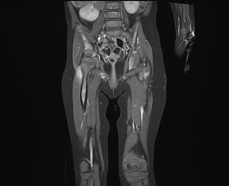 File:Neuroblastoma with bone metastases (Radiopaedia 67080-76414 E 14).jpg