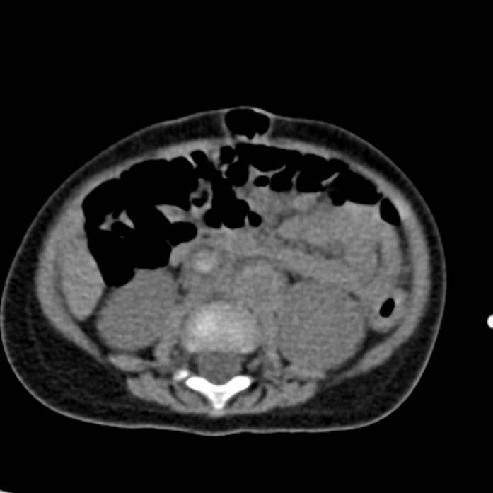 Neuroblastoma with skull metastases (Radiopaedia 30326-30960 Axial non-contrast 34).jpg