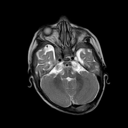 File:Neurofibromatosis type 1 (Radiopaedia 30089-30671 Axial T2 6).jpg
