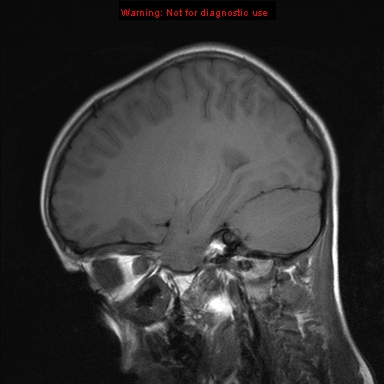 File:Neurofibromatosis type 1 with optic nerve glioma (Radiopaedia 16288-15965 Sagittal T1 8).jpg