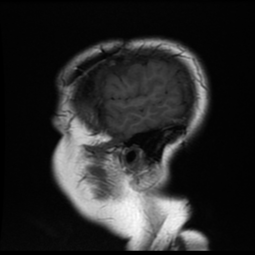 File:Neurofibromatosis type 2 (Radiopaedia 45229-49247 Sagittal T1 19).png