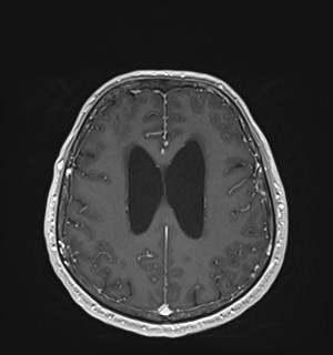Neurofibromatosis type 2 (Radiopaedia 79097-92049 Axial T1 C+ 135).jpg