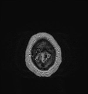 Neurofibromatosis type 2 (Radiopaedia 79097-92049 Axial T1 C+ 183).jpg