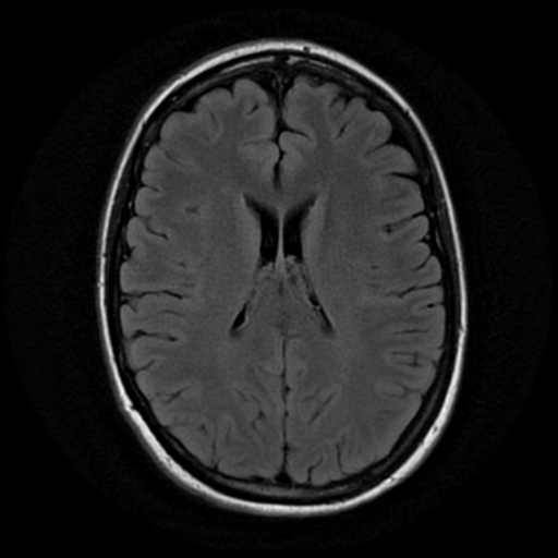 File:Neurofibromatosis type 2 - bilateral acoustic neuromata (Radiopaedia 40060-42566 Axial FLAIR 13).png