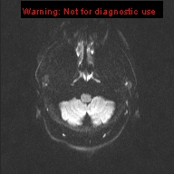 File:Neuroglial cyst (Radiopaedia 10713-11184 Axial DWI 43).jpg