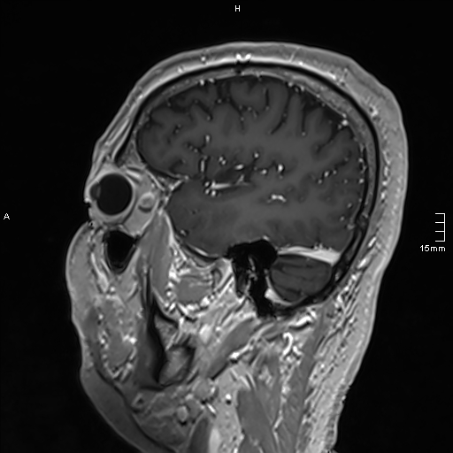 Neurosarcoidosis - involvement of the mesial temporal lobes (Radiopaedia 67429-76820 Sagittal T1 C+ 41).jpg