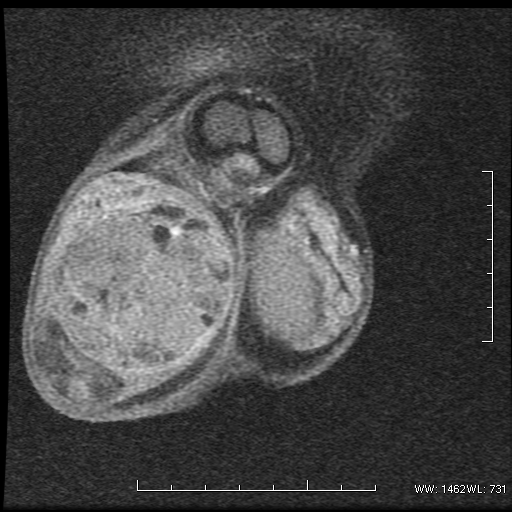 File:Non-seminomatous germ cell tumor (Radiopaedia 16649-16352 Coronal T1 C+ 5).png
