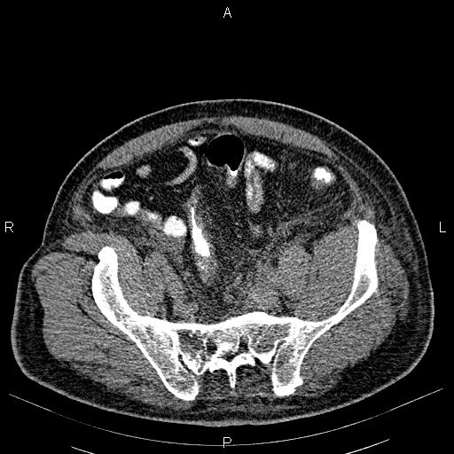 File:Non Hodgkin lymphoma in a patient with ankylosing spondylitis (Radiopaedia 84323-99621 Axial non-contrast 51).jpg