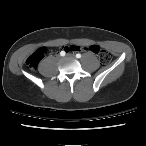 File:Normal CT angiogram of pelvis (Radiopaedia 45390-49430 A 20).jpg