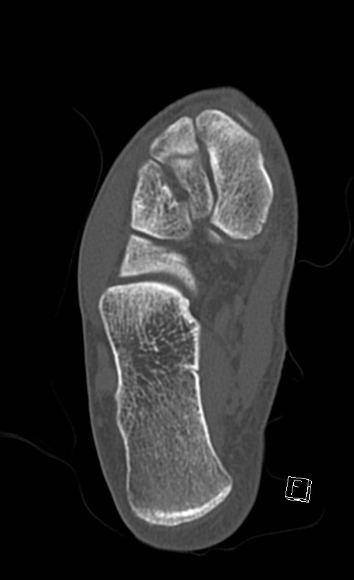 Normal CT of the ankle (Radiopaedia 47111-51658 Axial bone window 70).jpg