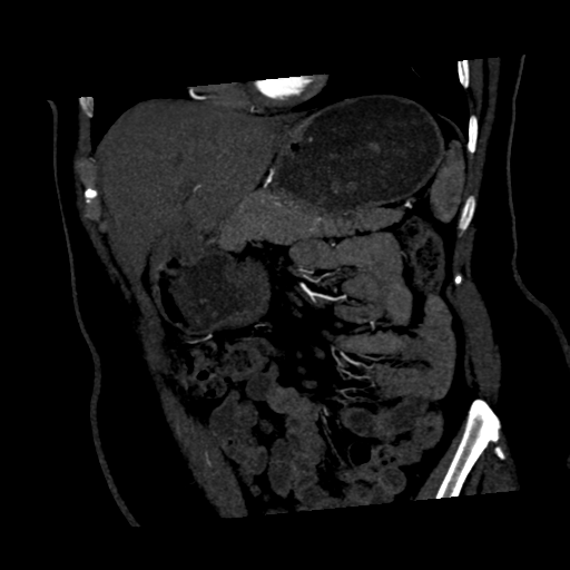 File:Normal CT renal artery angiogram (Radiopaedia 38727-40889 C 4).png