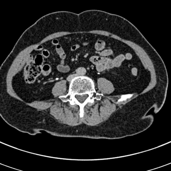 File:Normal CT split bolus study of the renal tract (Radiopaedia 48631-53634 Axial split bolus 162).jpg