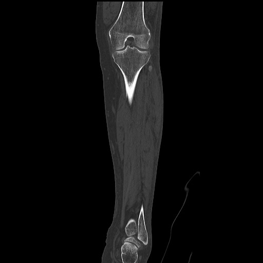 Normal CT tibia and fibula (Radiopaedia 51195-56848 Coronal non-contrast 38).jpg
