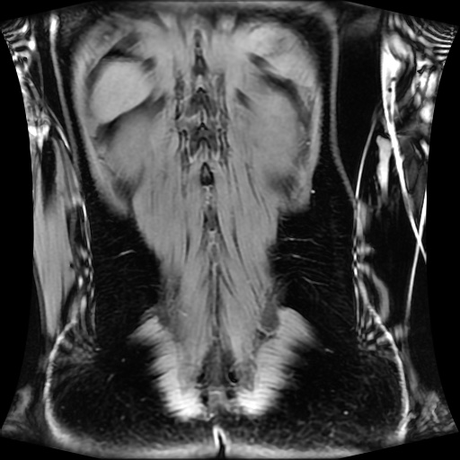 Normal MRI abdomen in pregnancy (Radiopaedia 88001-104541 M 117).jpg