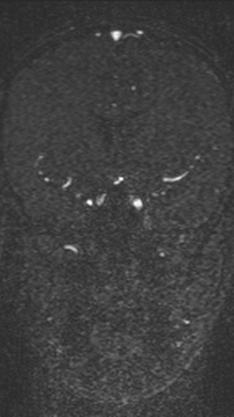 Normal MRI brain with MRV- teenager (Radiopaedia 49425-54553 Coronal MRV 107).jpg