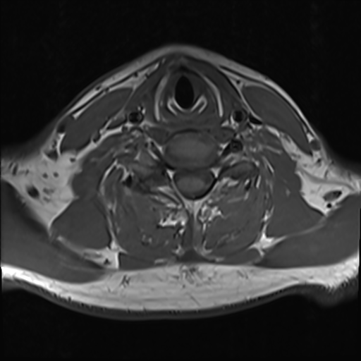 File:Normal MRI cervical spine (infection protocol) (Radiopaedia 53916-60039 Axial 35).png