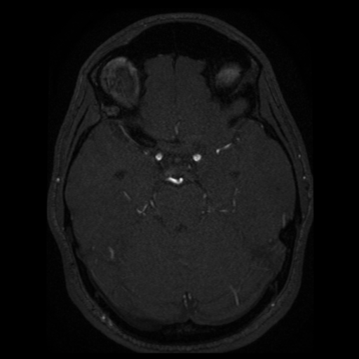 Normal brain MRA (Radiopaedia 41046-43793 Axial MRA 60).png