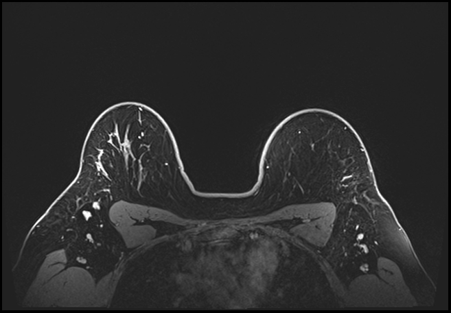 Normal breast MRI - dense breasts (Radiopaedia 80454-93850 C 177).jpg