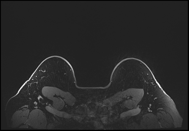 Normal breast MRI - dense breasts (Radiopaedia 80454-93850 C 209).jpg