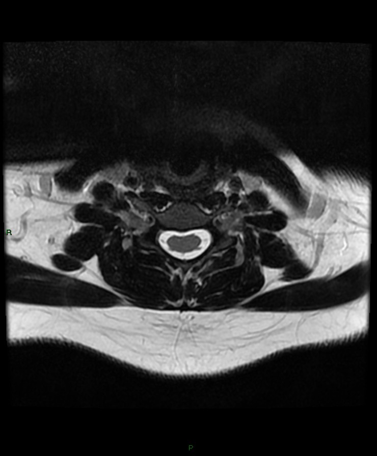 Normal cervical spine MRI (Radiopaedia 80146-93454 Axial T2 64).jpg