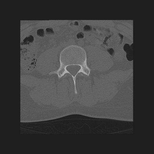 File:Normal lumbar spine CT (Radiopaedia 46533-50986 Sagittal bone window 1).png