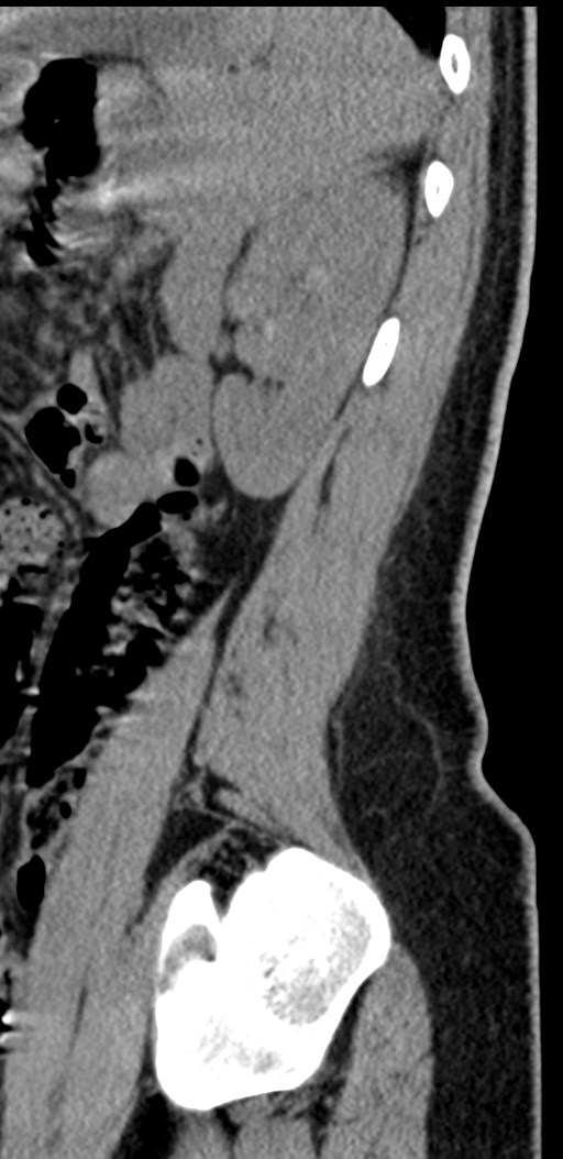 Normal lumbosacral CT (Radiopaedia 37923-39867 E 20).png