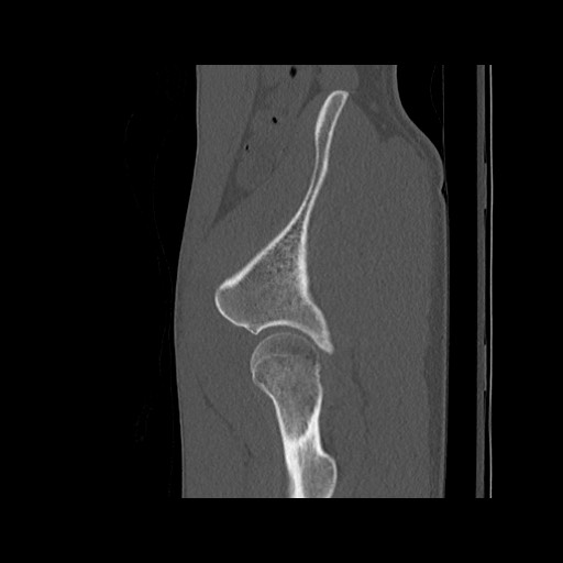 Normal pelvis (Radiopaedia 51473-57238 Sagittal bone window 121).jpg