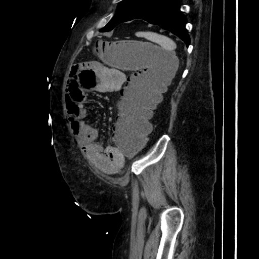 Obstructive colonic diverticular stricture (Radiopaedia 81085-94675 C 189).jpg