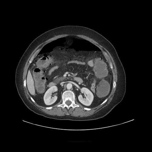 Obstructive distal colonic adenocarcinoma causing cecal perforation (Radiopaedia 86830-102989 A 81).jpg