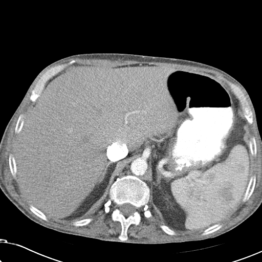 File:Obstructive superior vena cava tumor thrombus (Radiopaedia 28046-28306 A 53).jpg