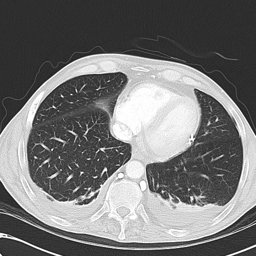 File:Obstructive superior vena cava tumor thrombus (Radiopaedia 28046-28306 Axial lung window 41).jpg