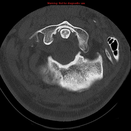 File:Occipital condyle fracture (Radiopaedia 18366-18208 Axial bone window 15).jpg