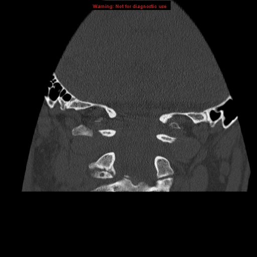File:Occipital condyle fracture (Radiopaedia 18366-18208 Coronal bone window 17).jpg