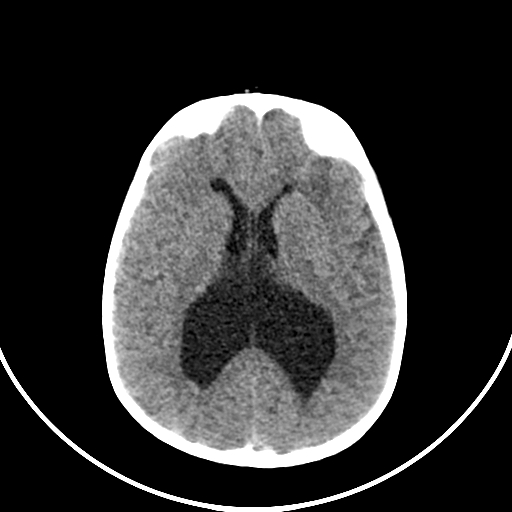 Occipital encephalocele (Radiopaedia 87339-103636 Axial non-contrast 48).jpg