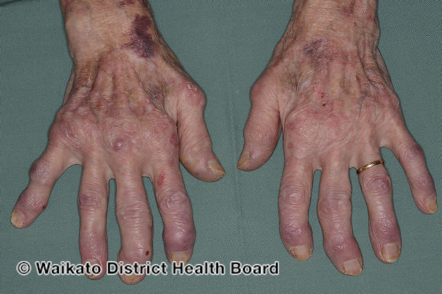 File:Rheumatoid arthritis (DermNet NZ rheumatoid-hands).jpg