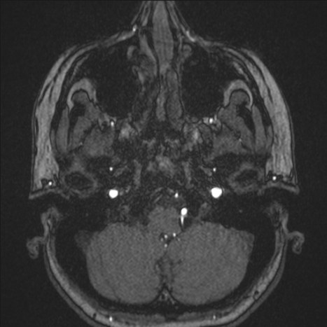 A1 segment hypoplasia (Radiopaedia 83365-97781 Axial TOF MRA 15).jpg