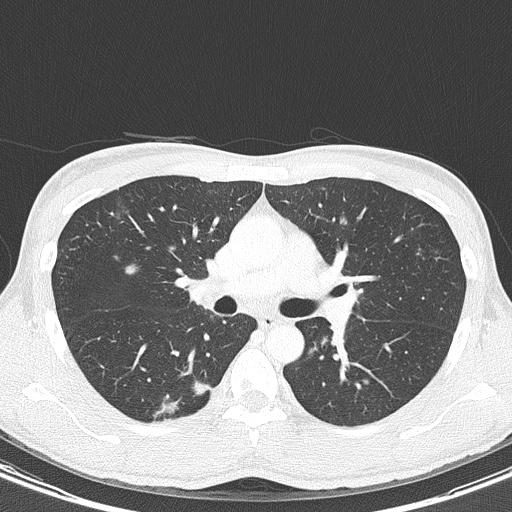 File:AIDS-related Kaposi sarcoma (Radiopaedia 85247-100811 Axial lung window 70).jpg